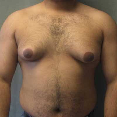 male gynaecomastia doctors in hyderabad